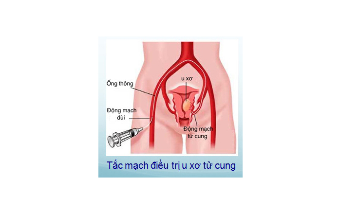 Tắc mạch u xơ tử cung