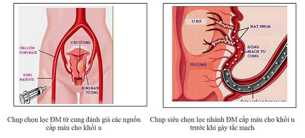 Sau nút mạch u xơ tử cung phụ nữ có thể gặp những vấn đề gì