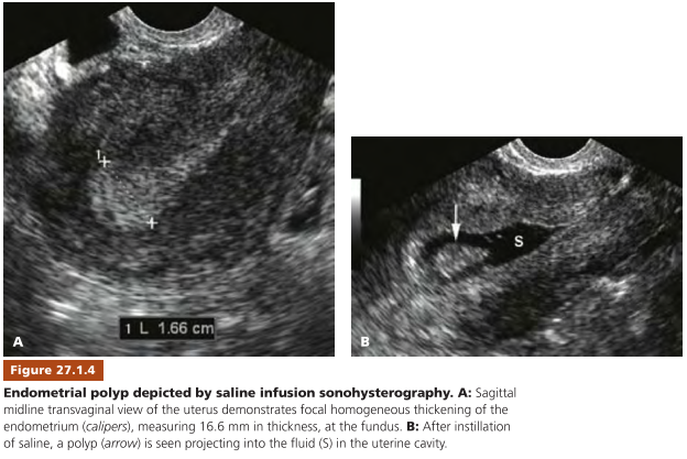 Khối echo hỗn hợp lòng tử cung có mạch máu nuôi, tổng quan