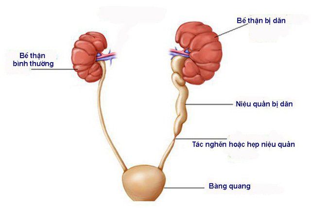 Phẫu thuật thắt động mạch tử cung trong cấp cứu sản phụ khoa