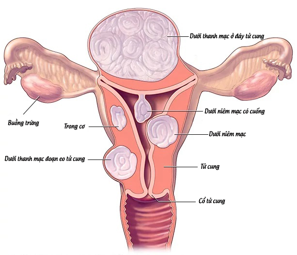 Phụ nữ có u xơ tử cung cần theo dõi những gì