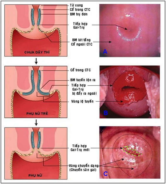 Giải phẫu bệnh lý bệnh lý cổ tử cung