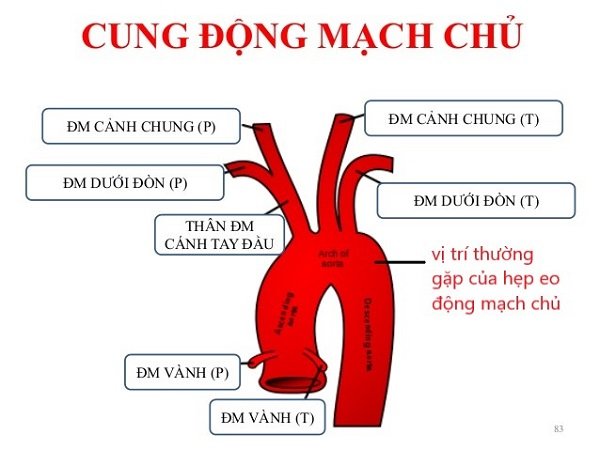 Hẹp eo động mạch chủ bệnh tim bẩm sinh dễ bị bỏ sót