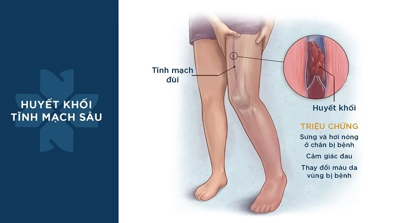Tử chi huyết mạch: nguyên nhân, triệu chứng và phương pháp Điều trị